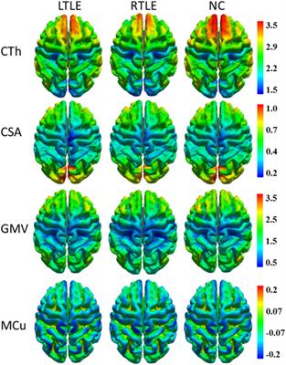 A Comparative Study of Feature Selection Methods for the Discriminative Analysis of Temporal Lobe Epilepsy